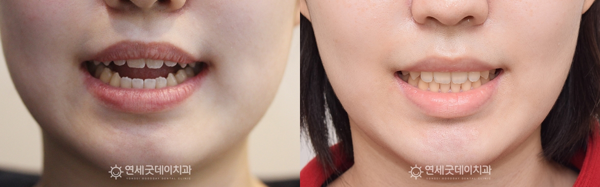 개방교합 재교정 치료전후 안모 비교