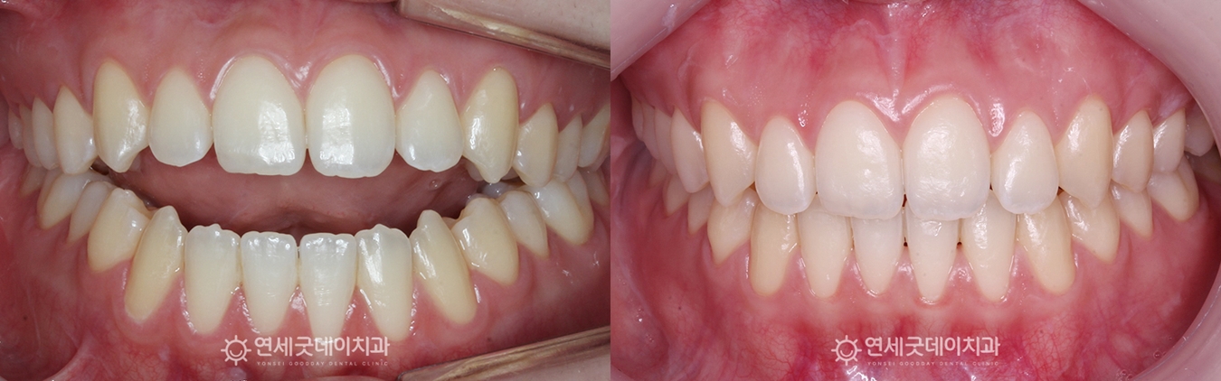 개방교합 재교정 치료전후 구내 비교