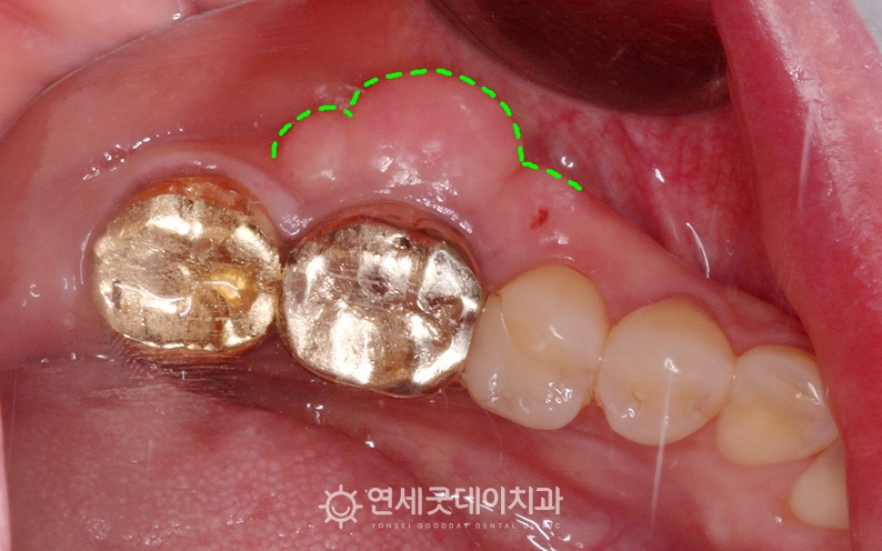 잇몸뼈돌출로 인해 골융기절제술 희망, 치료전 모습