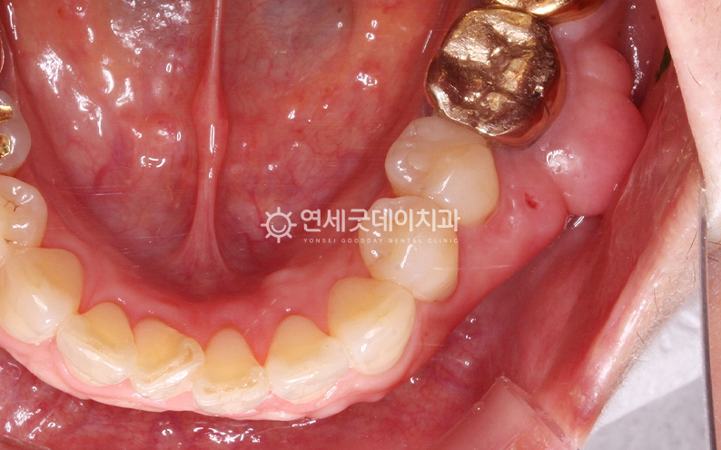 골융기절제술 전 심하게 잇몸뼈 돌출이 진행된 모습