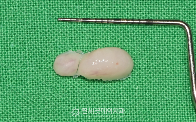 골융기절제술을 통한 잇몸뼈 돌출 제거