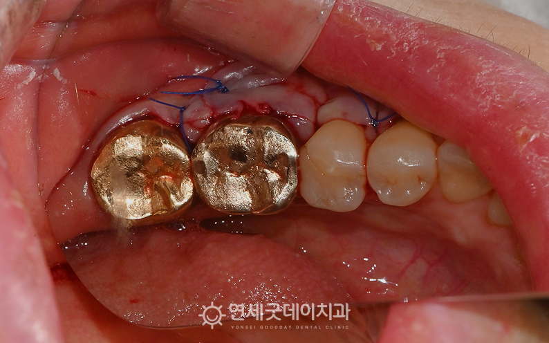 잇몸뼈 돌출(골융기절제술) 제거 직후