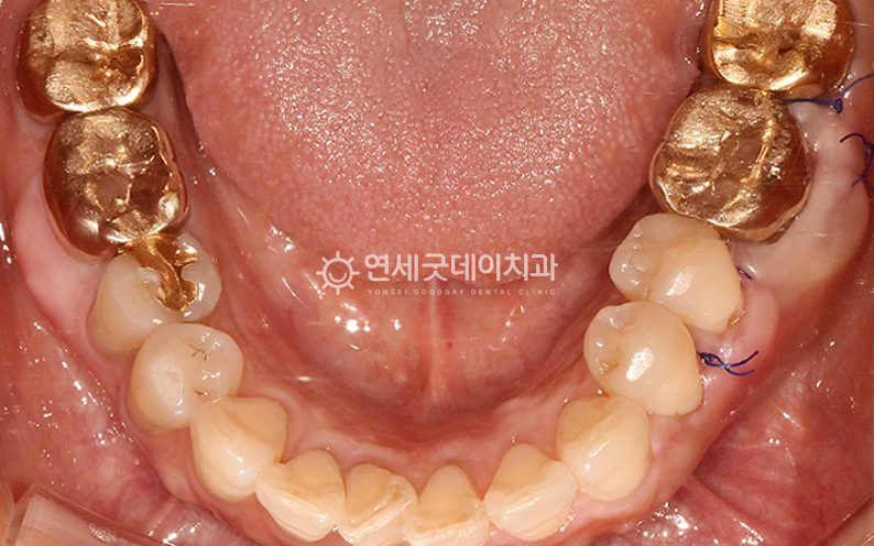 골융기절제술 후 잇몸뼈 돌출이 완화된 모습