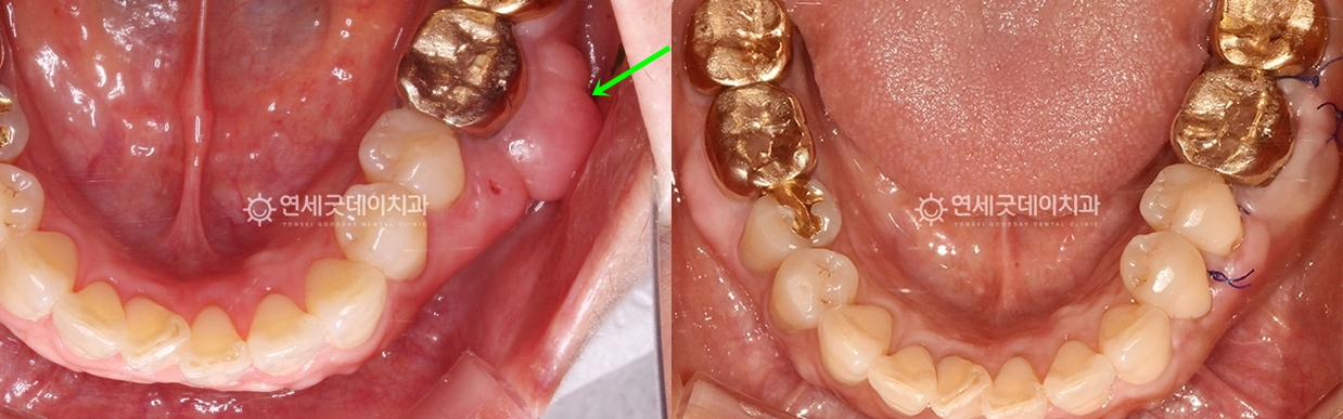 골융기절제술 치료전후 구내 비교