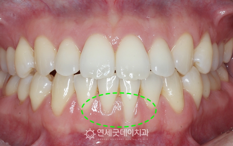 부분교정 및 잇몸이식수술 치료전 모습. 잇몸퇴축 부위