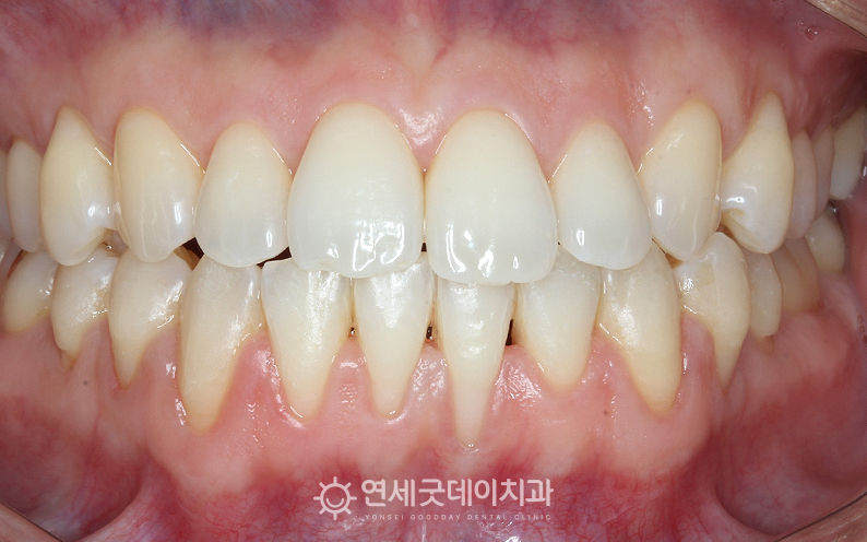 부분교정 8개월 진행 후, 잇몸이식수술 진행 전 모습