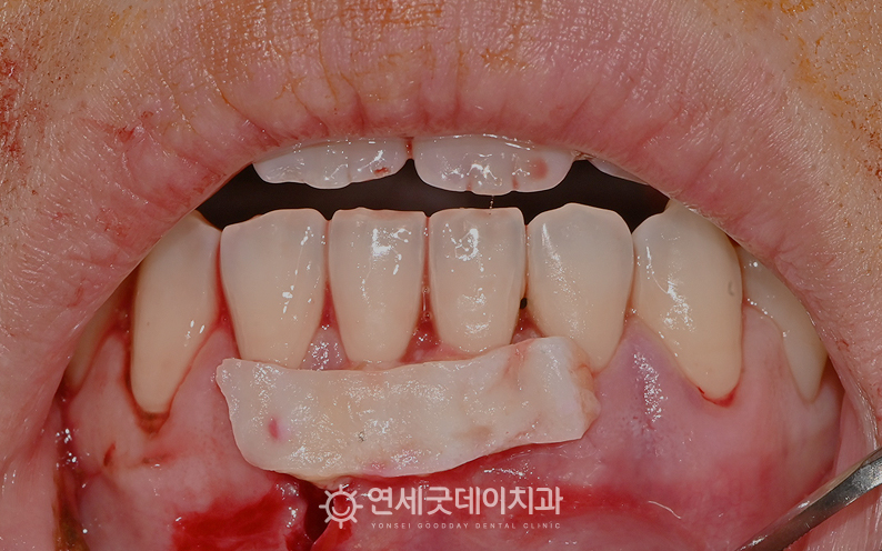 잇몸이식수술 과정(1) 콜라겐