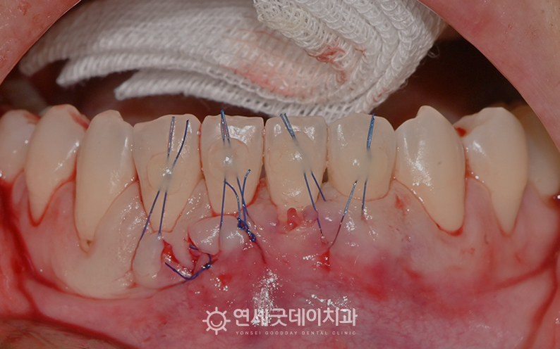 잇몸이식수술 과정(2) 잇몸조직, 콜라겐, 엠도게인 적용 후 봉합