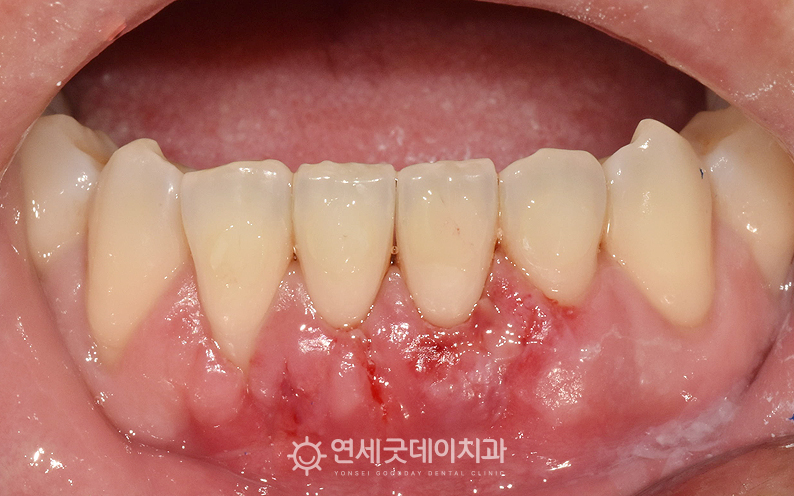 부분교정 후 잇몸이식수술 진행하였으며 치유중인 모습