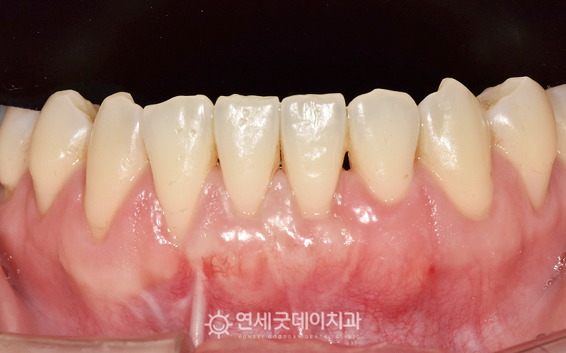 부분교정 및 잇몸이식수술 종결 치주교정 후 치아와 잇몸 모두 회복된 모습
