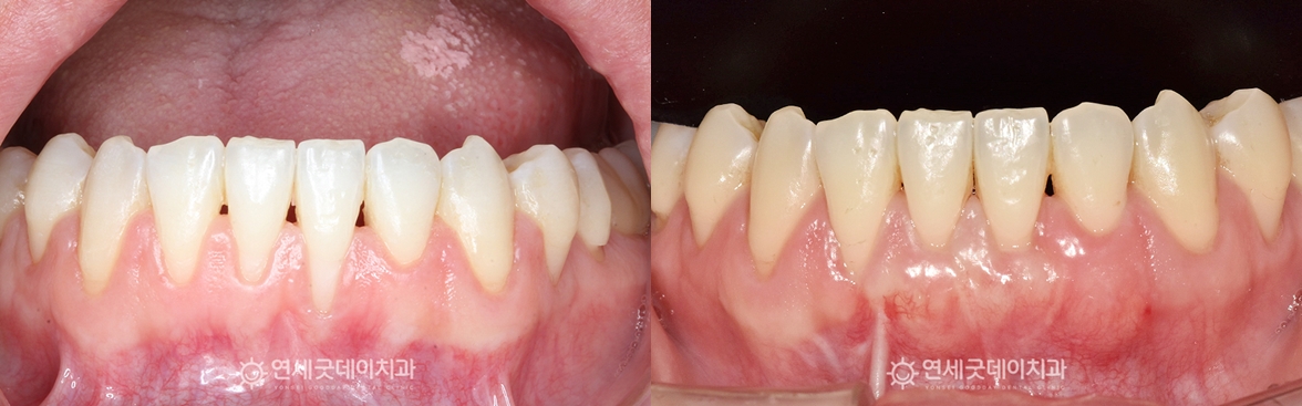 치주교정(부분교정+잇몸이식수술) 치료전후 구내 비교