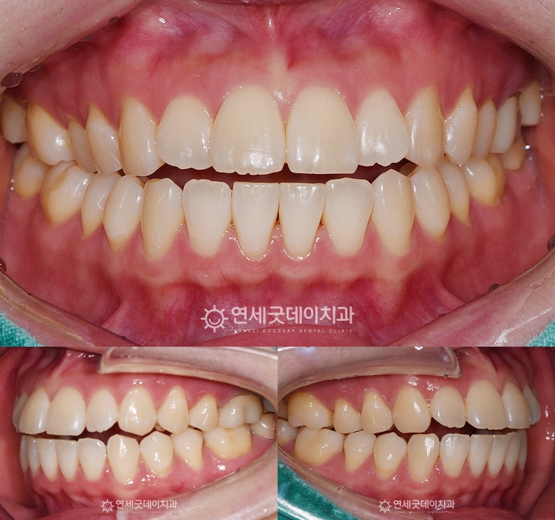 오픈바이트로 인한 트랙션 턱교정 치료전 모습