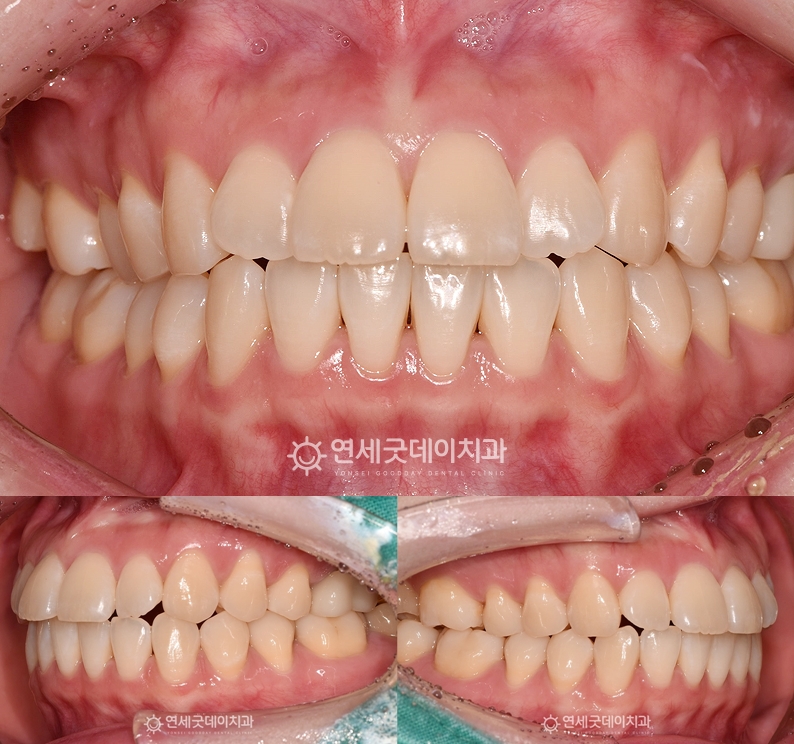 트랙션을 이용한 턱교정 후 오픈바이트 많이 개선됨