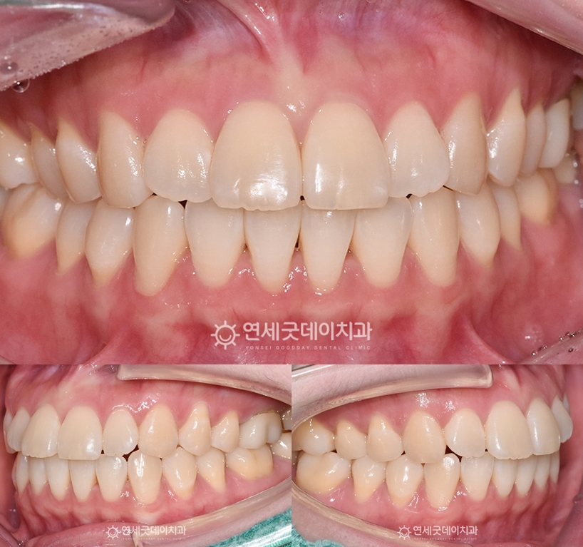 트랙션을 이용한 턱교정 완료 후 오픈바이트 개선됨