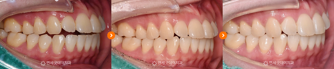 트랙션을 이용한 오픈바이트 및 턱교정 과정