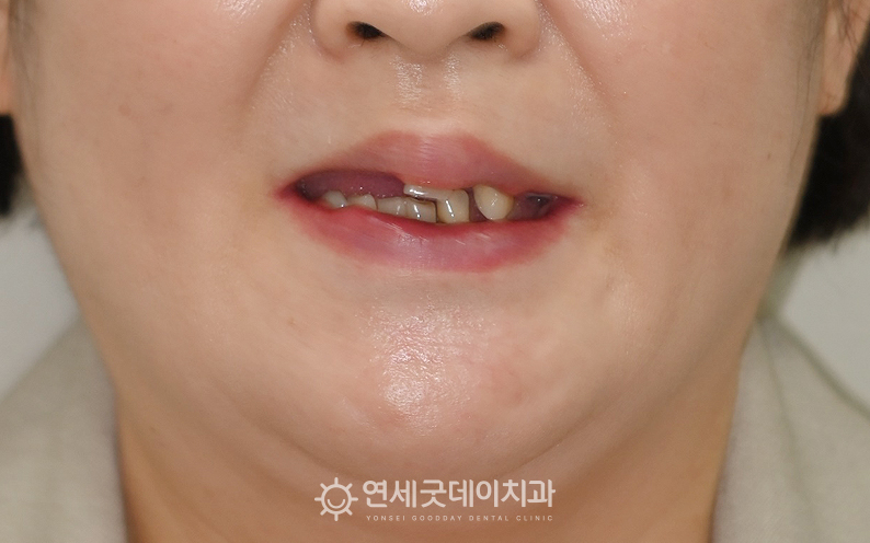 전체임플란트 치료 전 얼굴 정면