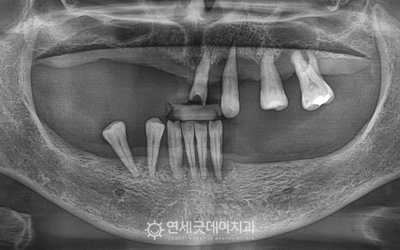 상악동수술을 동반한 전체임플란트 치료전 모습
