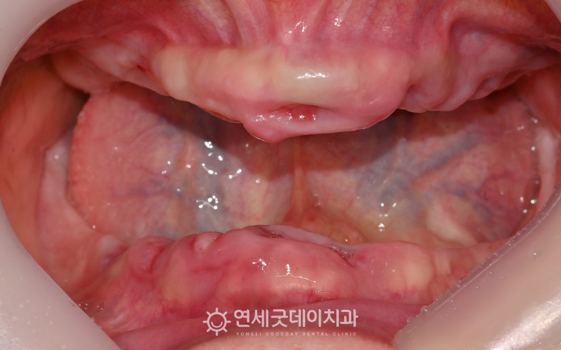 전체임플란트 및 상악동수술을 위해 잔존치 발치