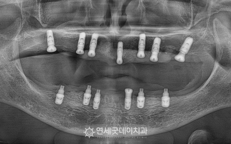 상악동수술 진행 및 전체임플란트 식립