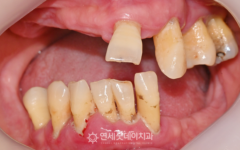 치료전 다수의 치아가 손실되어 전체임플란트가 필요한 케이스