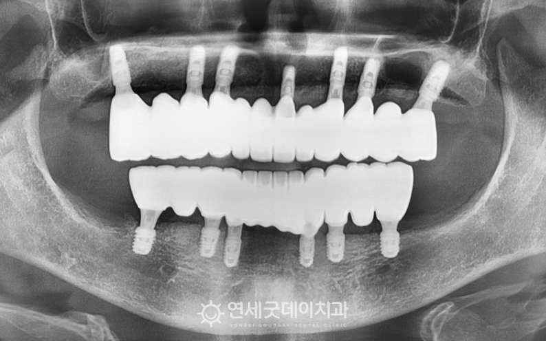 전체임플란트 치료 후 모습