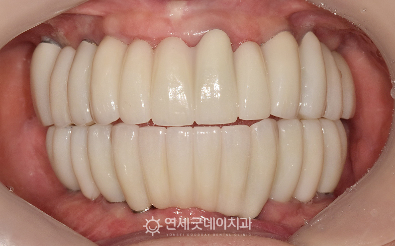 상악동수술과 전체임플란트 치료 후 구내 정면