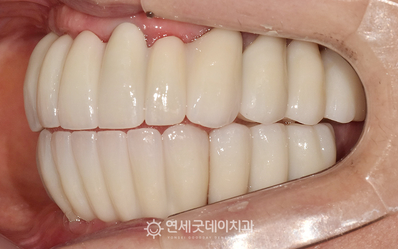 상악동수술과 전체임플란트 치료 후 구내 측면