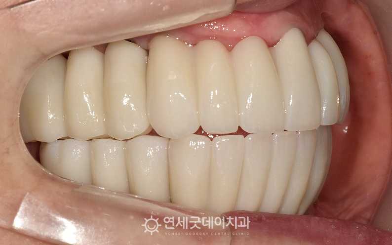 상악동수술과 전체임플란트 치료 후 구내 축면