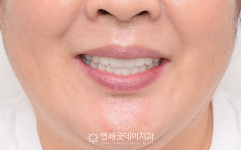 상악동수술과 전체임플란트 치료 후 얼굴 정면