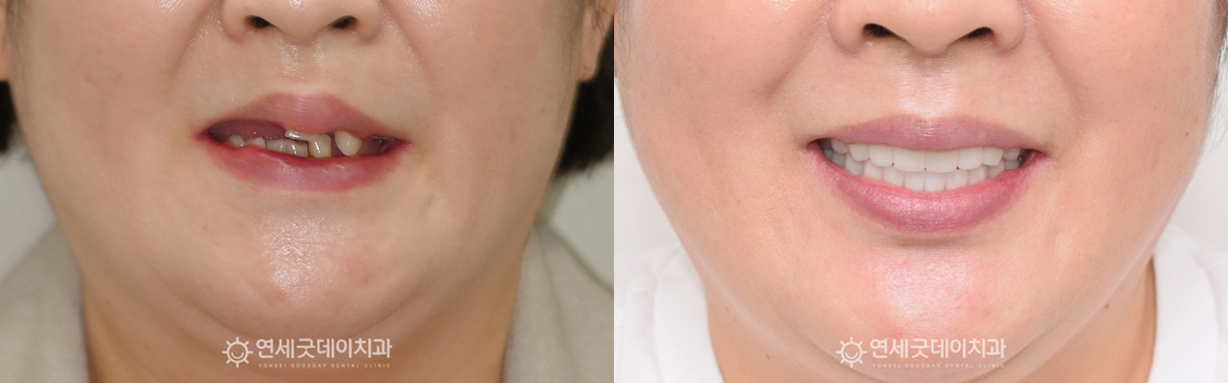 상악동수술 후 전체임플란트 치료 전후 안모비교