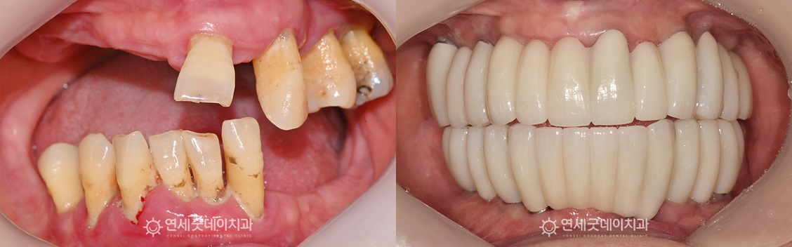 상악동수술 후 전체임플란트 치료 전후 구내 비교