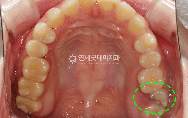 신경치료 전 구내모습 (상악)