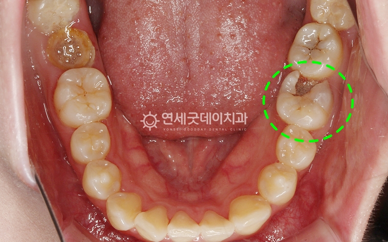신경치료 전 구내모습 (하악)