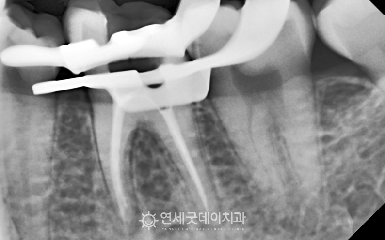 신경치료 과정 중 포스트를 세우는 모습