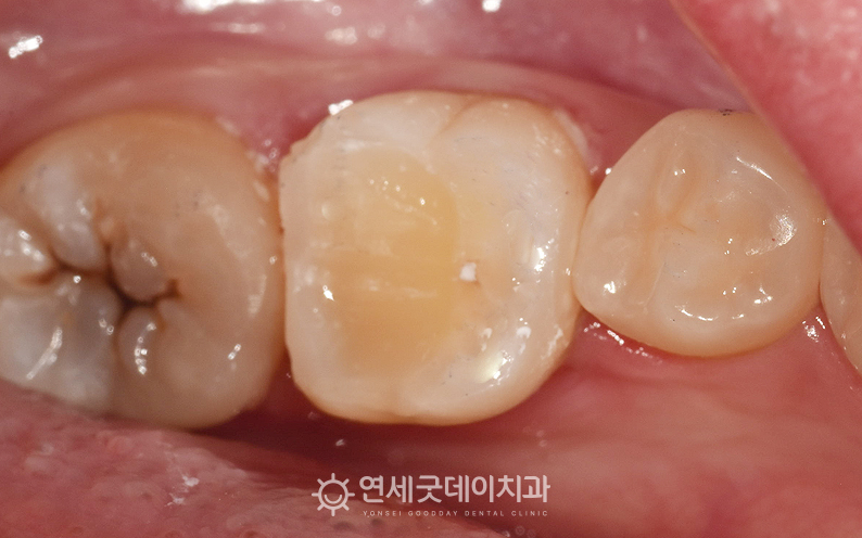 신경치료 후 크라운을 씌우기 전 레진코어로 외형을 회복한 모습