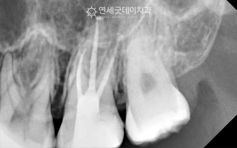 신경치료 후 모습