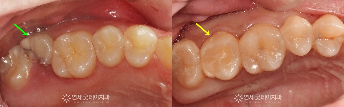 신경치료 후 크라운을 씌우기 전 하악 구내모습