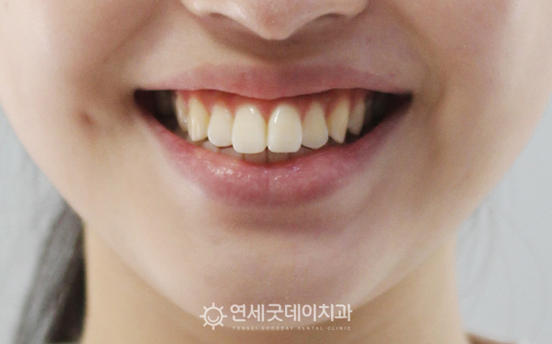 돌출입교정 전 안모 정면 모습