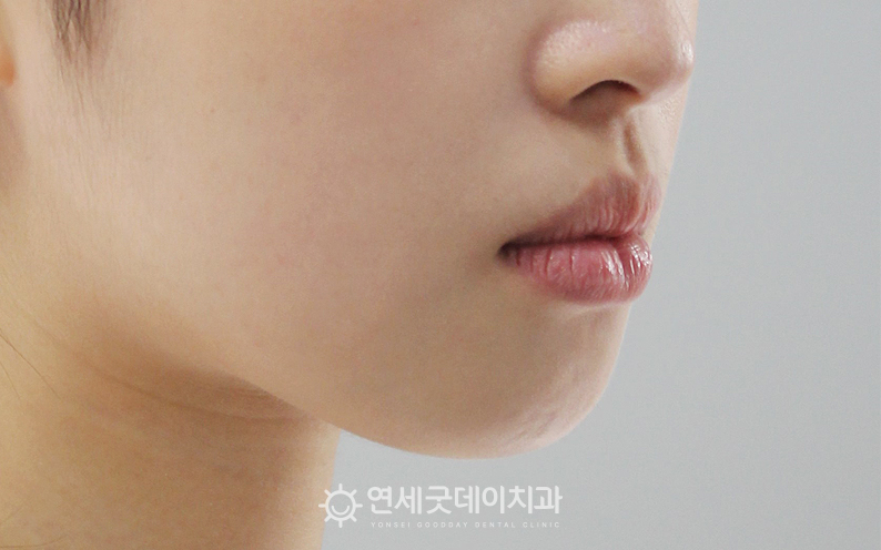 돌출입교정 전 옆모습