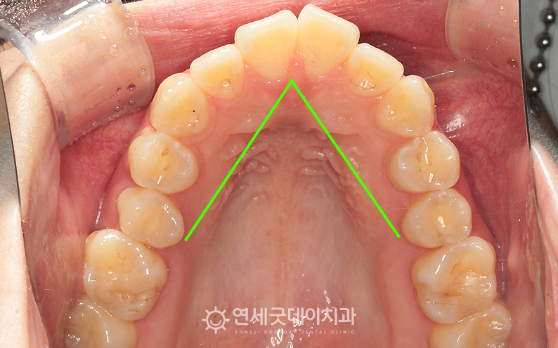 돌출입교정 전 좁은 V자 형태의 악궁