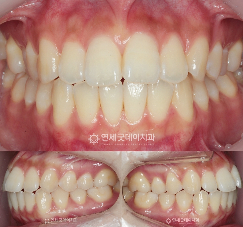 돌출입 비발치교정 치료전