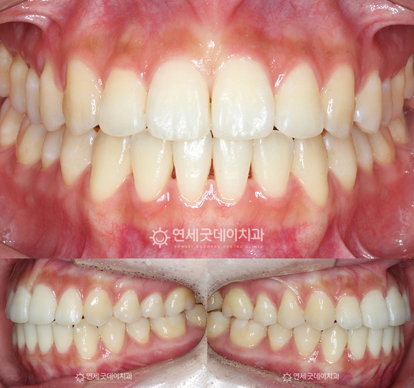 돌출입 비발치교정 후 모습