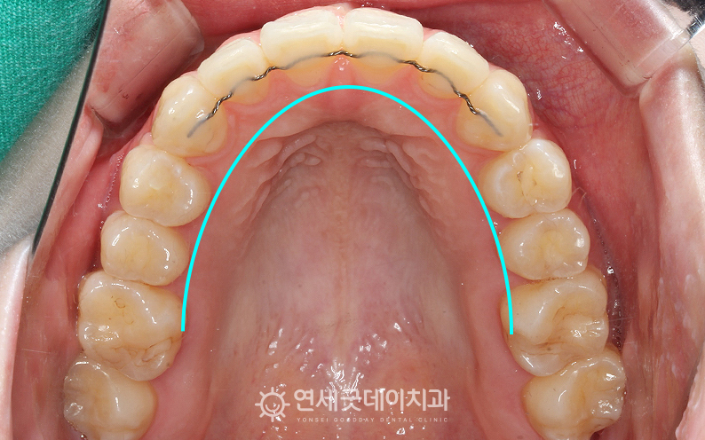 돌출입교정 후 상악 악궁이 U자 형태로 개선됨