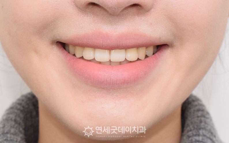 비발치교정을 통한 돌출입교정 후 스마일라인 변화