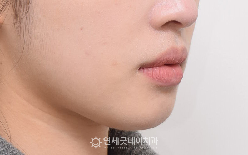 비발치교정을 통한 돌출입교정 후 옆모습 변화