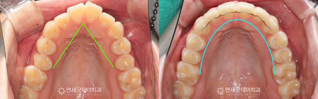 돌출입 비발치교정 악궁전후 비교