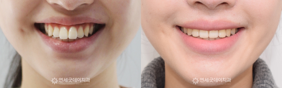 돌출입 비발치교정 스마일라인 전후 비교