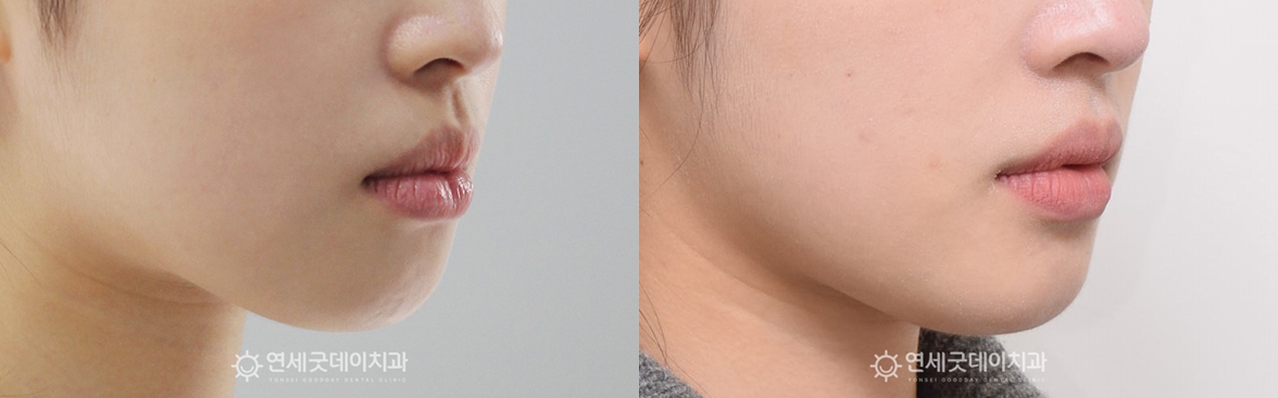 돌출입 비발치교정 옆모습 전후 비교
