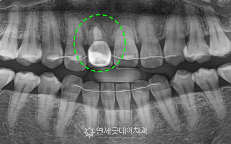 30대 앞니 임플란트 전 엑스레이