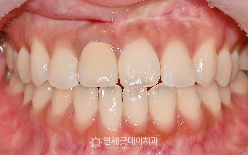 30대 앞니 임플란트 전 구내모습